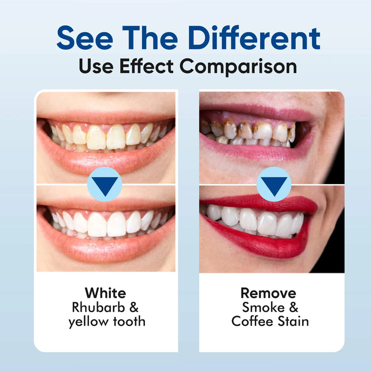 Teeth Whitening Kit, Non-Sensitive Tooth Whitener Professional Oral Care Tools